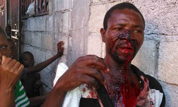 HAITI: Un homme blessé à l’arme blanche pour une dette de 100 gourdes ( Vidéo Choquante )