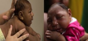 Monde: Une mère haitienne infectée du virus Zika donne naissance à un bébé atteint de microcéphalie